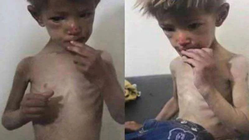 أطباء بلا حدود..16 شهيداً بسبب سوء التغذية بمضايا والحصار مستمر