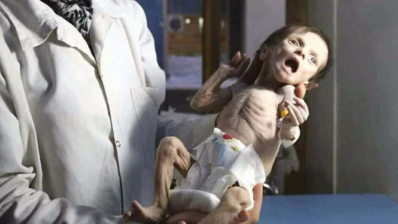 الجوع يفتك بأطفال الغوطة الشرقية.. وفاة طفلة رضيعة بسبب سوء التغذية