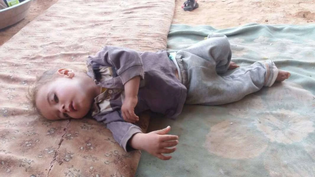 رقم صادم للمصابين بالحصبة في 6 محافظات سورية