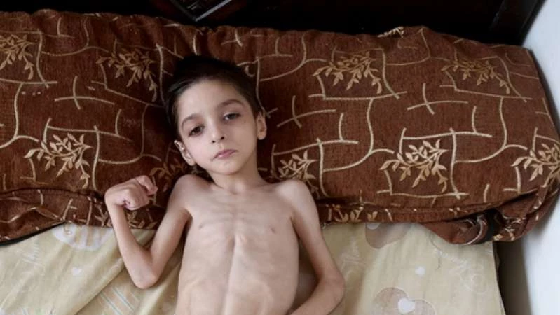 وفاة الطفلة السورية "رهف حوا" إحدى ضحايا نظام الأسد