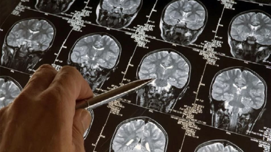 دراسة تكشف عن نظام جديد أدق وأسرع لتشخيص أورام الدماغ