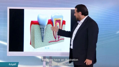 The Clinic explains dental implant